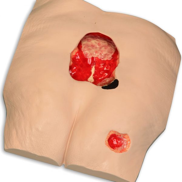 Stan Stage 4 Pressure Injury Model